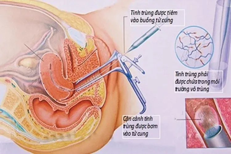 Thụ tinh ống nghiệm và các quy trình thụ tinh nhân tạo bạn cần biết