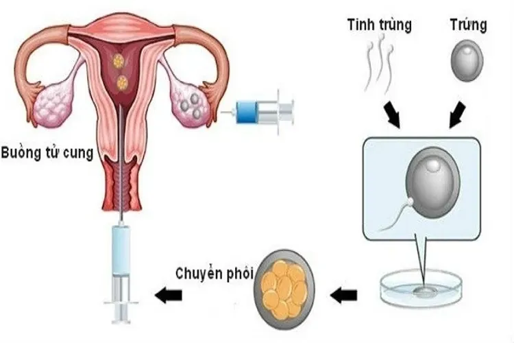 Thụ tinh trong ống nghiệm tỷ lệ thành công là bao nhiêu