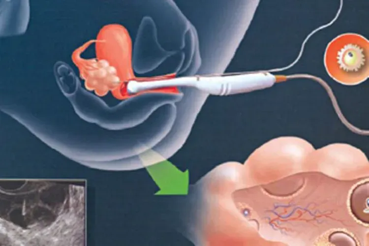 Thuốc kích rụng trứng kèm theo một số lưu ý chị em không nên bỏ qua