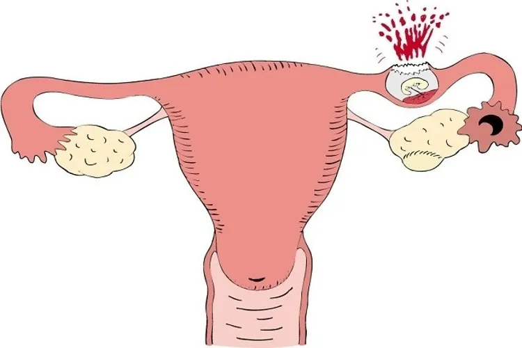 Thuốc phá thai Alsoben và những điều có thể bạn chưa biết