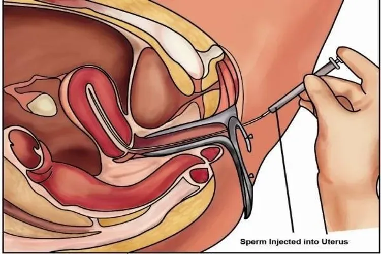 Tìm hiểu 4 cách sinh con không cần"chuyện ấy"