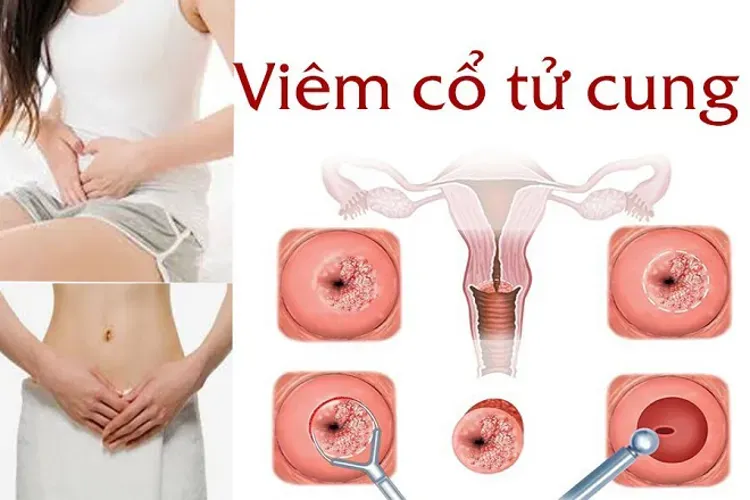 Top 7 các bệnh phụ khoa nguy hiểm mà chị em phụ nữ thường gặp