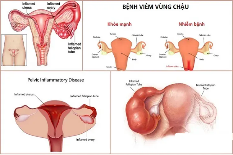 Top 7 các bệnh phụ khoa nguy hiểm mà chị em phụ nữ thường gặp