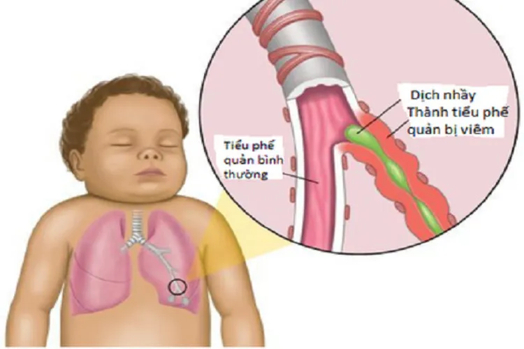 Trẻ sơ sinh bị đờm nhớt gây khò khè – mẹ nên làm gì để giúp con cải thiện?