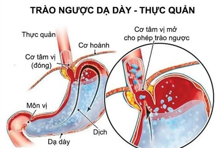 Trẻ sơ sinh bị trớ do trào ngược dạ dày thực quản