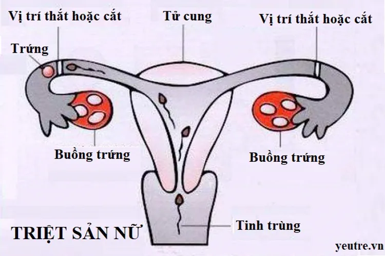 Triệt sản có kinh nguyệt không và câu trả lời chính xác nhất cho bạn