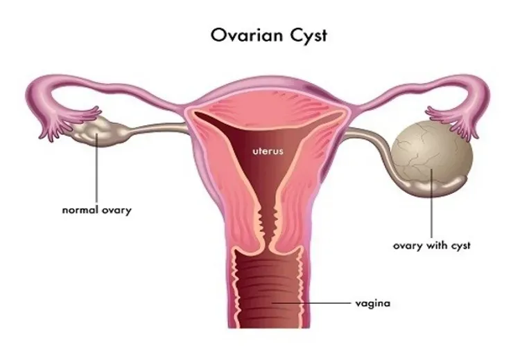 U nang buồng trứng có nguy hiểm và có gây vô sinh không?