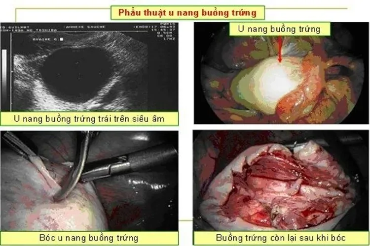 U nang buồng trứng có nguy hiểm và có gây vô sinh không?