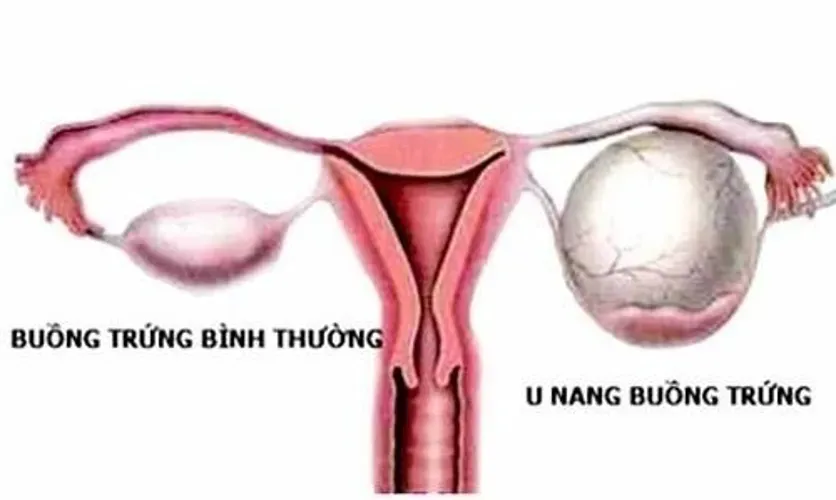 U nang buồng trứng khi mang thai dễ khiến mẹ sẩy thai, sinh non