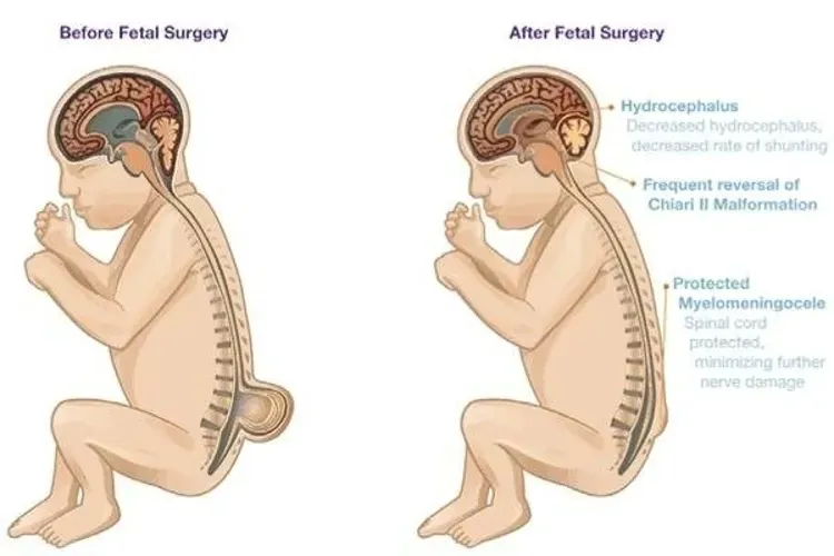 Vai trò tối quan trọng của axit folic đối với sự hình thành và phát triển thai nhi