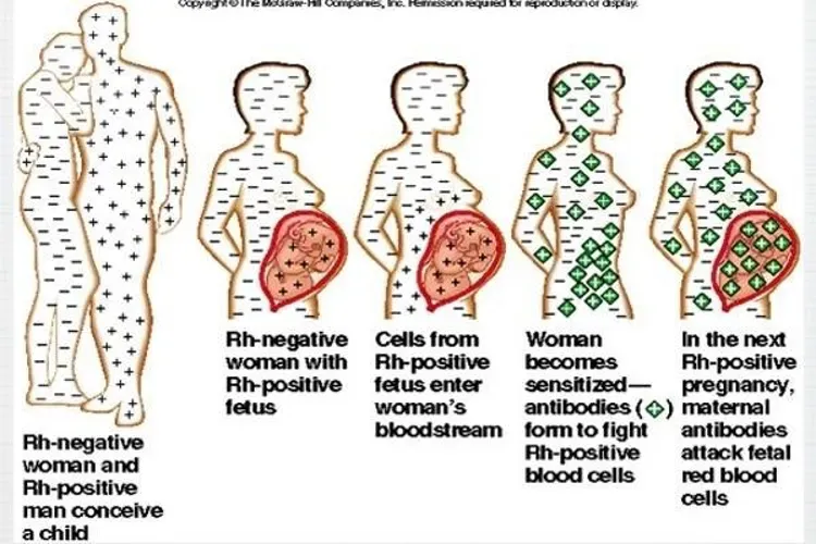 Yếu tố Rh ảnh hưởng như thế nào đến thai nhi và thai phụ?